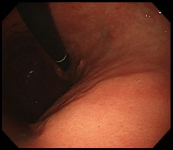 胃の体中部小弯という場所にできた分化型早期胃がんの症例写真1