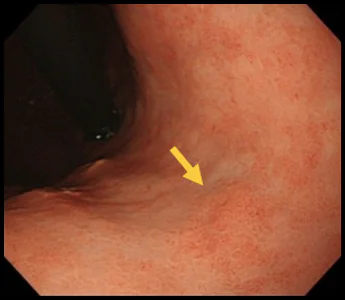 胃の体中部小弯という場所にできた分化型早期胃がんの症例写真2