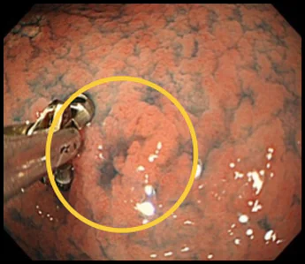 胃の体中部小弯という場所にできた分化型早期胃がんの症例写真3