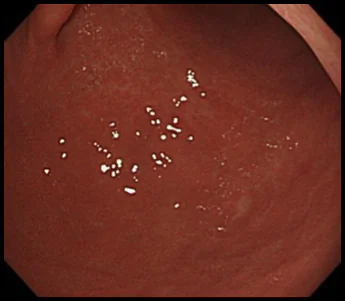 胃の体下部大弯という場所にある未分化早期胃がんの症例写真1