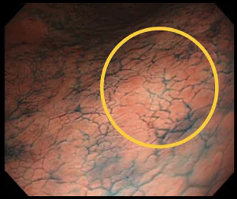 胃の体下部大弯という場所にある未分化早期胃がんの症例写真3