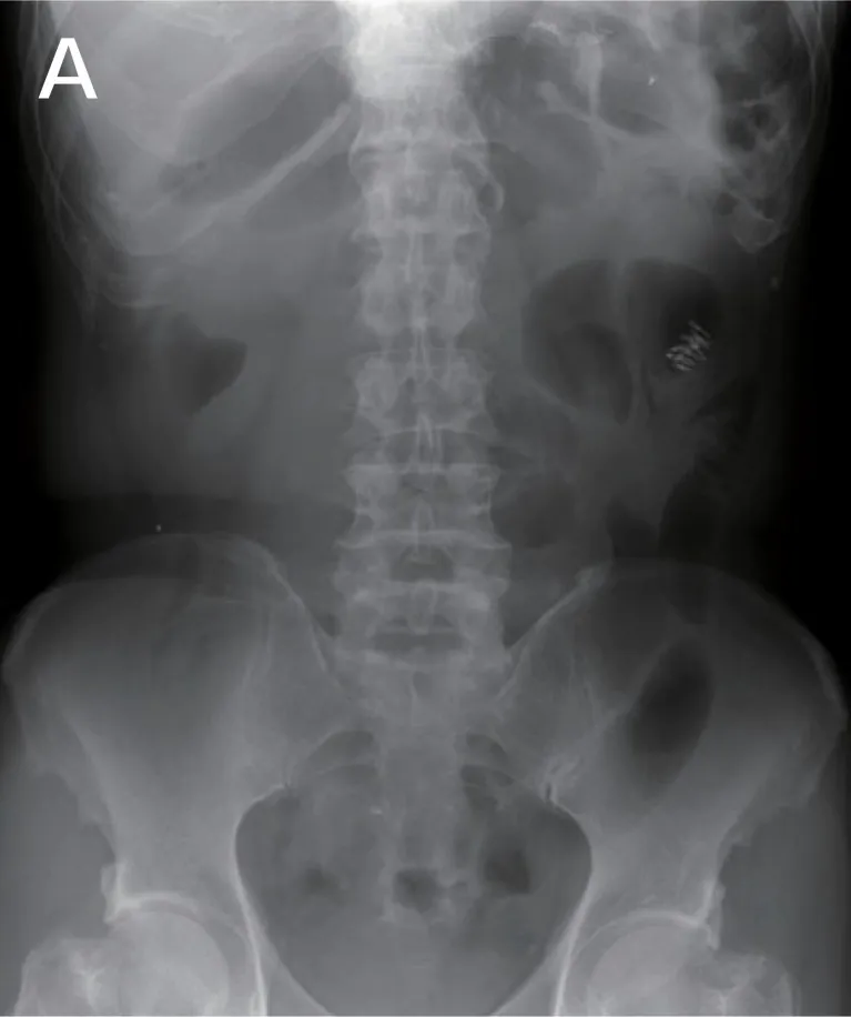 内視鏡検査後に撮影した腹部レントゲン写真A
