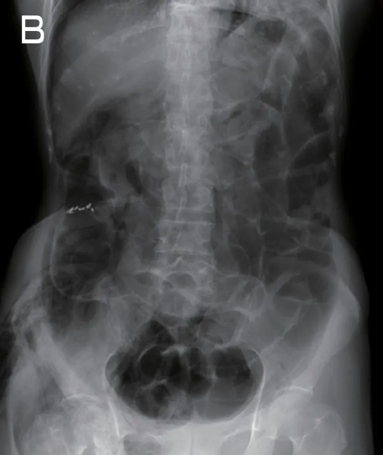 内視鏡検査後に撮影した腹部レントゲン写真B
